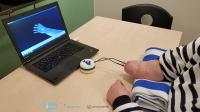 Geschickt und empfindsam: erste erfolgreiche Implantation einer neuartigen Handprothese