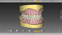 Totalprothese mit inLab Software 20.0 - einfach digital