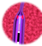Mit schönen Beinen in den Sommer: Ambulante Laser-Behandlung ELVeS® PainLess zur narben- und schmerzfreien Krampfaderentfernung auf sanfte Weise