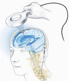 Neuentwicklung für Hydrozephalus-Behandlung: "Aesculap-Miethke SensorReservoir"