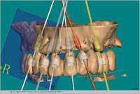 Alle wichtigen Guided Systeme in CeHa imPLANT® von C. HAFNER integriert