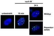 Brustkrebs: BRCA-Mutationen und strahleninduzierte DNA-Schäden