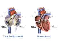 2 U.S. Hospitals Begin Certification To Implant SynCardia Total Artificial Heart