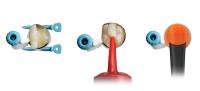 Komposithybrid Surefil one ist eine weiße Alternative zu Amalgam