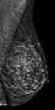 Ergebnis einer neuen Studie zeigt: Bessere Detektion von Brustkrebs durch Kombination aus 2D- und 3D-Mammographie im Vergleich zu Standard 2D-Mammographie