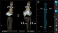 Brainlab präsentiert neuentwickelte Navigationssoftware Knee 3
