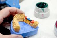 Zahnlücke schließen - Brücke oder Implantat?