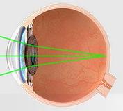 Klar sehen ohne Brille: 95% der Patienten sind zufrieden