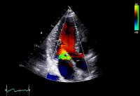 Highlights der echokardiographischen Diagnostik und Therapie kardiovaskulärer Erkrankungen 2018 in Leipzig