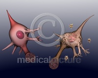 Morbus Alzheimer