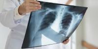 3D-gedruckte bioresorbierbare Atemwegsstents