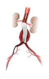 Zenith® Low Profile AAA Stent Graft von Cook Medical erhält CE-Kennzeichnung