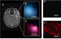 Neuer Fluoreszenzmarker macht Grenzen von Hirntumoren sichtbar