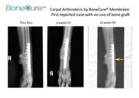 RegeneCure Starts Worldwide Veterinary Distribution of BoneCure Membrane Implant for Acceleration of Fracture Healing and Carpal Arthrodesis