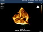 NASA untersucht mit Philips Live 3D Ultraschall die Raumfahrt-Auswirkungen auf die Herzen der Space Shuttle Astronauten