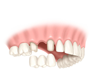Wie viele Implantate dürfen es sein?