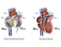 SynCardia Total Artificial Heart Featured On 60 Minutes Australia