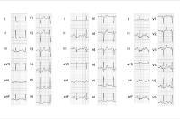 Studie bestätigt: Körperhaltung für 4-Elektroden EKG, CardioSecur, unerheblich