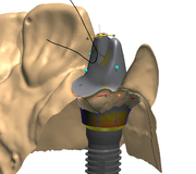 Mit cara individuelle Abutments einfach und schnell gestalten
