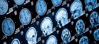 Hirnimplantat bietet Hoffnung für Epileptiker