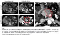 Dual-Layer Spektral-CT: Bessere Therapieplanung beim Bauchspeicheldrüsenkrebs