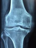 TS Treppenlifte: Nie wieder Schmerzen im Knie beim Treppensteigen!