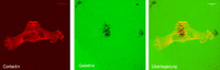 Neue Messmethode für invasive Tumorzellen