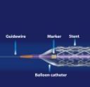 Stent, Endoprothese, Stentprothese
