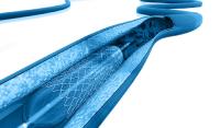 Medical Device Regulation: Transitioning from MDD to MDR