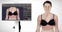 Psoriasis: Fotodokumentation hilft Patienten