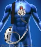 Surgeons Worldwide Implanted a Record 125 SynCardia Total Artificial Hearts So Far in 2013
