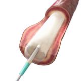 Positive Zwölf-Monats-Ergebnisse für Paclitaxel- freisetzenden Ballonkatheter Passeo-18 Lux von BIOTRONIK