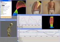 Motion Capture mit AVT-Kameras erleichtert orthopädische Diagnosen