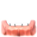 condent präsentiert renommierte Miniimplantat-Linie in Halle 10.1