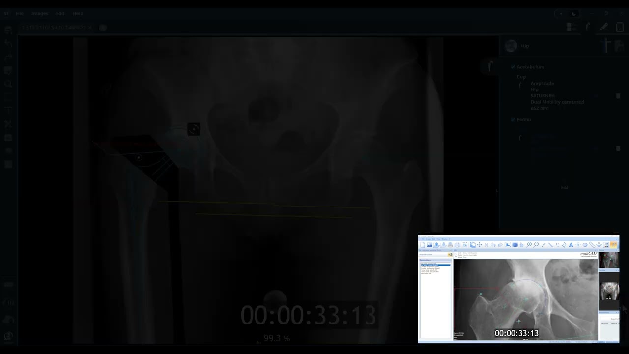 mediCAD® 8 vs. mediCAD® 7