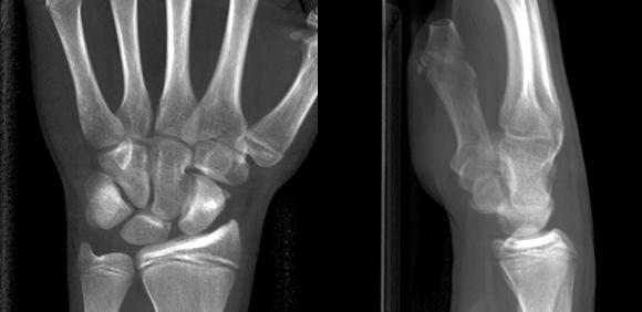 15 jähriger Patient mit Extensionstrauma des linken Handgelenkes. Die Röntgenaufnahmen des Handgelenkes zeigen eine unregelmäßige Darstellung der radialen Gelenkfläche des Mondbeines bei noch offenen Wachstumsfugen