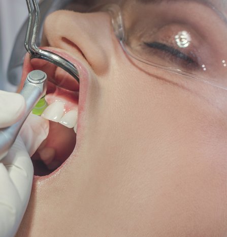 Polishing_with_Prophy_Cup_front_interdental_(mouth_picture).jpg