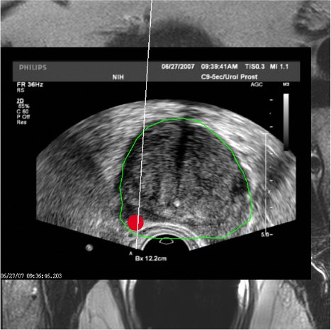 2Überlagerung von MRT- und Ultraschallbild fuer Prostata-Biopsie .png