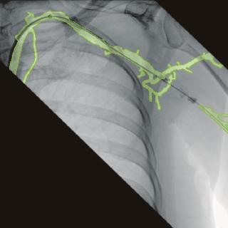 Enhanced Vessel Visualization