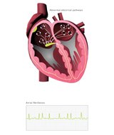 Heart_abnormal_electrical_pathways[1].jpg