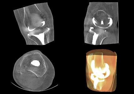 Fall 1 – Eine 3-D-Schnittbildaufnahme des Knies nach erfolgreicher Knie-TEP mit Metallartefaktunterdrückung (ARA)
