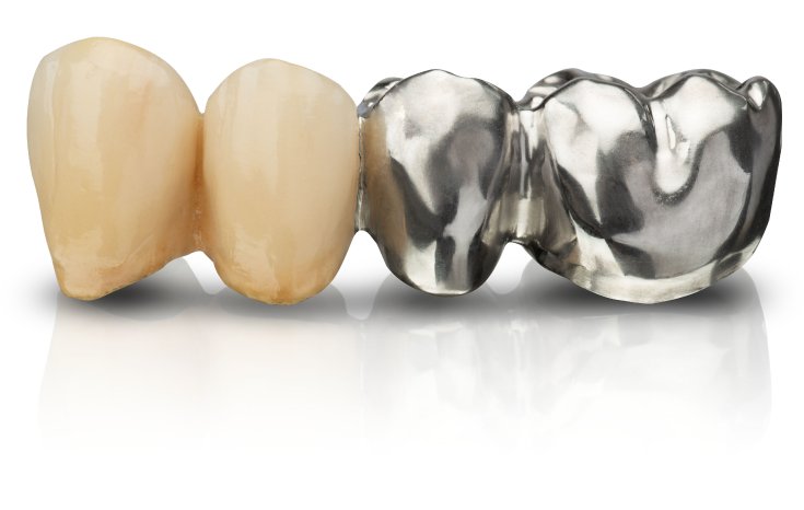 Wirobond M+ Brücke Verblendet IMG_8261 Kopie.jpg