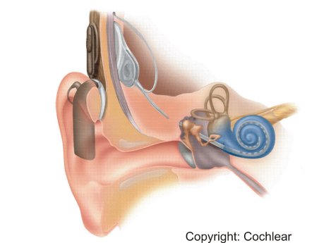 12_04_19_cochlea_implantat-ef-rh.jpg