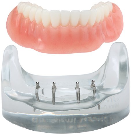 Zur Stabilisierung und Fixierung von Unterkieferprothesen haben sich 3M ESPE MDI Mini-Denta.jpg