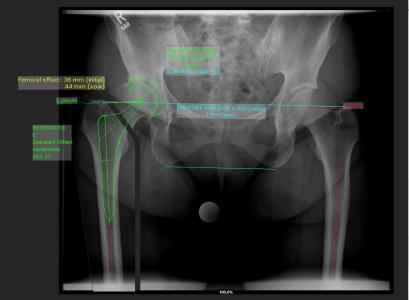 Digital preoperative planning with mediCAD with Aesculap implants