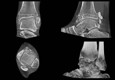 Arthrographie eines Sprunggelenks unter natürlicher Gelenkbelastung. U.a. sind freie Gelenkkörper deutlich sichtbar. (Priv.-Doz. Dr. J. Petermann – Main Medical Clinic GmbH)