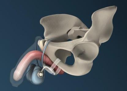 New ATOMS design with scrotal port