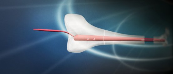 02_WITTENSTEIN_intens_FITBONE_Technische_Zeichnung.jpg
