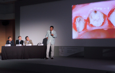 Prof. Antonio Cerutti (Brescia), Prof. Peter Eickholz (Frankfurt), Prof. Philippe Bouchard (Paris) und Prof. Stephen Chu (New York) diskutierten über die richtige Be-handlung des abgebrochenen rechten vorderen Schneidezahns