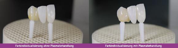 Farbindividualisierung von Implantaten ohne und mit Plasmabehandlung